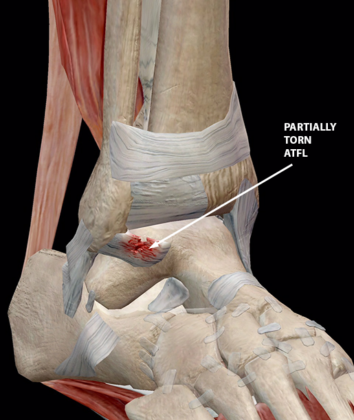 Common Ligament Injuries and Disorders